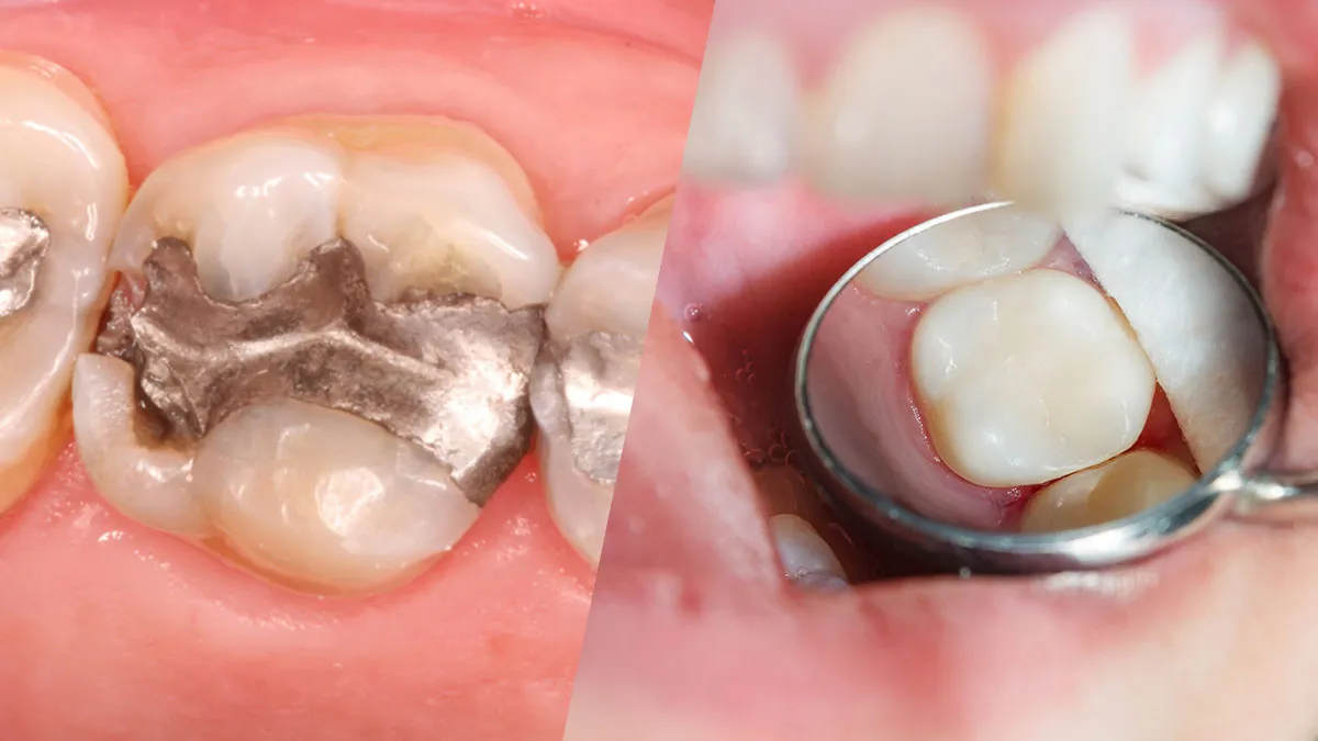 A Comprehensive Guide to White Fillings vs. Amalgam at Skymark Smile Centre Skymark Smile